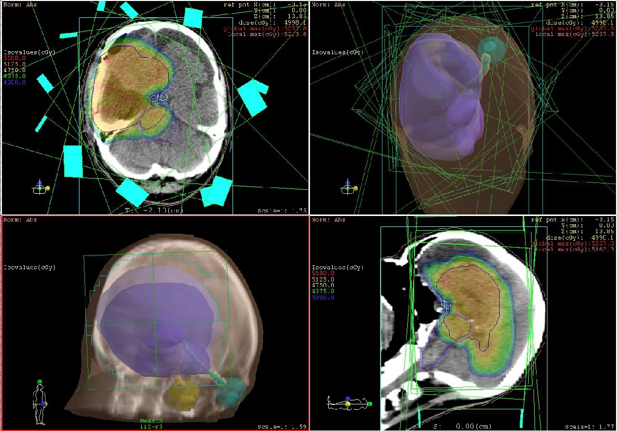 脳腫瘍の放射線治療